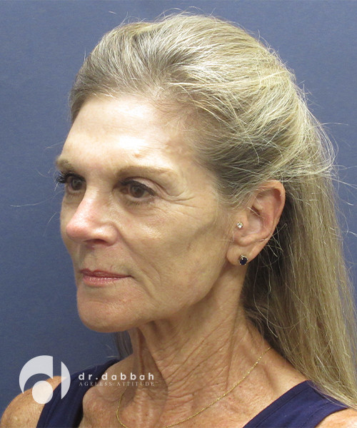 before neck lift surgery female patient left angled view case 2426