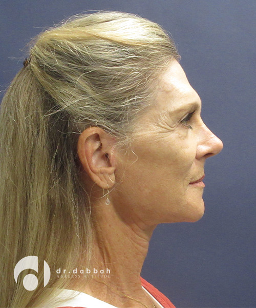 after neck lift surgery female patient right side view case 2426