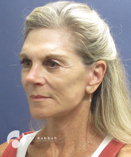 after neck lift surgery female patient left angled view case 2426