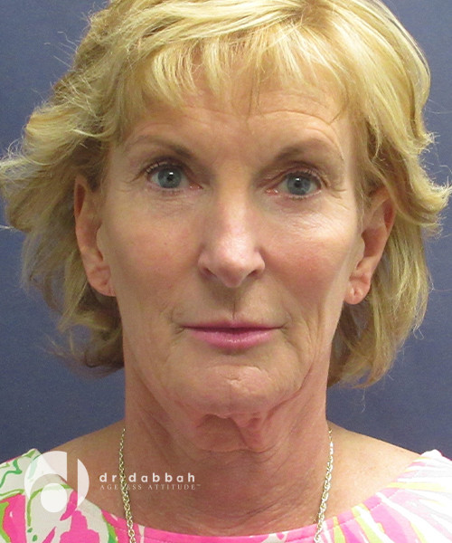 before neck lift female patient front view case 2448