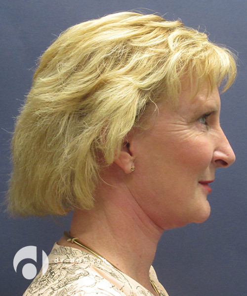 after neck lift female patient right side view case 2448