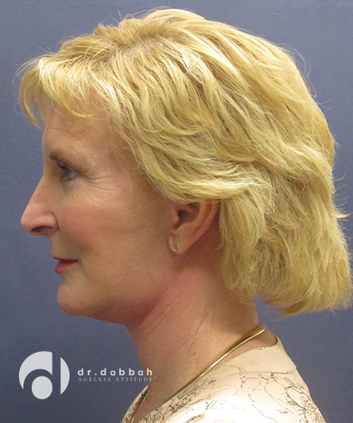 after neck lift female patient left side view case 2448