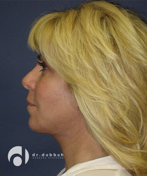 after neck lift female patient left side view case 2470