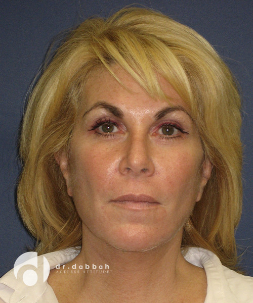 after neck lift female patient front view case 2470