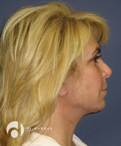 after neck lift female patient right side view case 2470