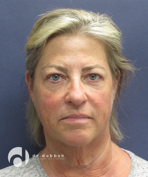 before neck lift front view female patient case 2492