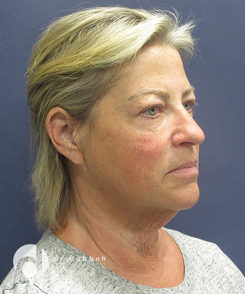 before neck lift right angle view female patient case 2492