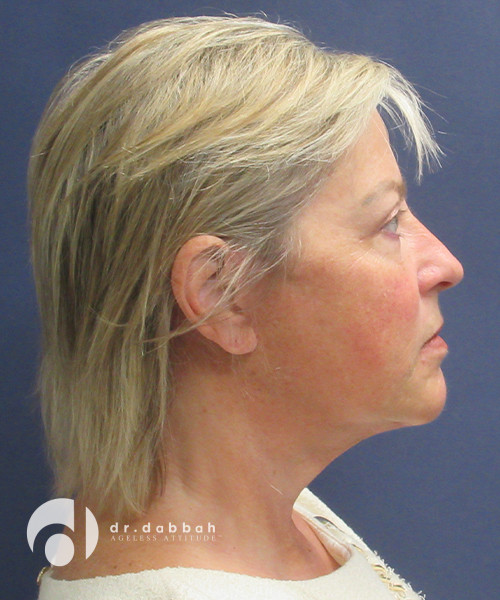 after neck lift right view female patient case 2492