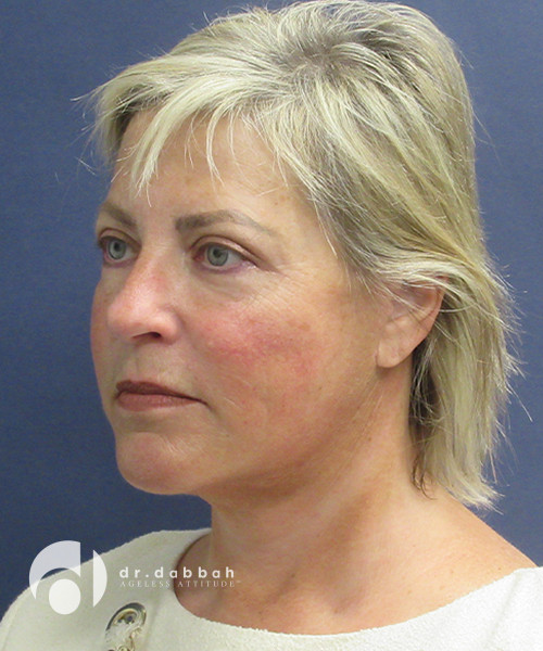 after neck lift female patient left angled view case 2492