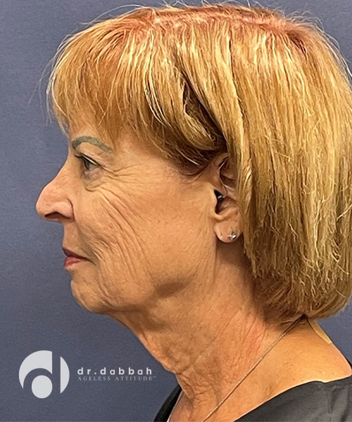 before neck lift left view female patient case 2503