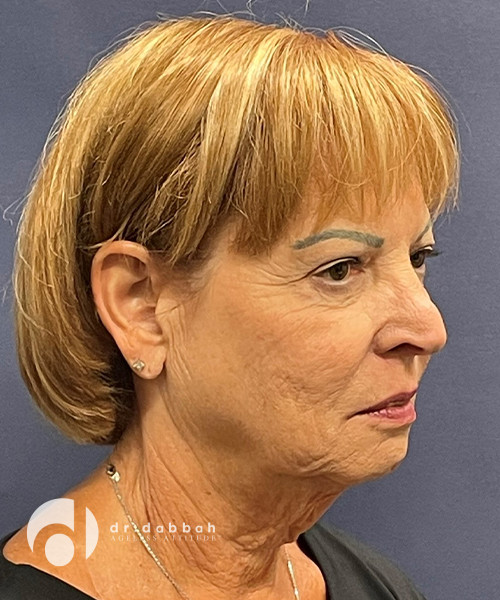 before neck lift right angle view female patient case 2503