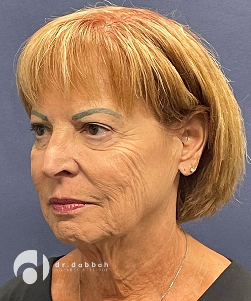 before neck lift left angle view female patient case 2503