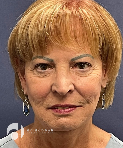 after neck lift front view female patient case 2503