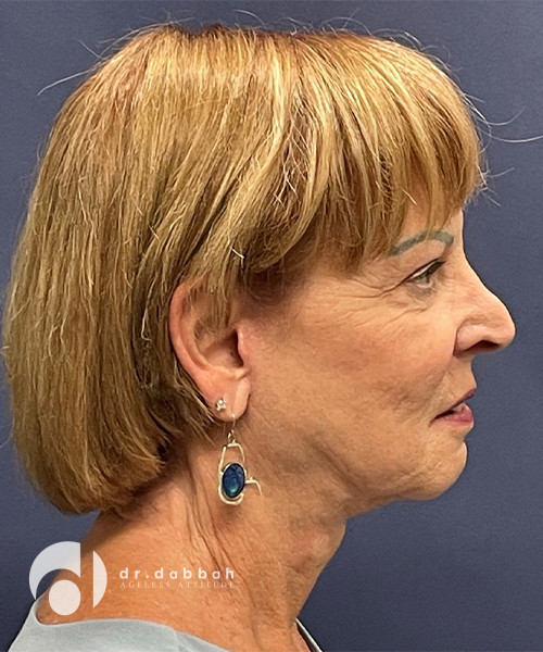 after neck lift right view female patient case 2503