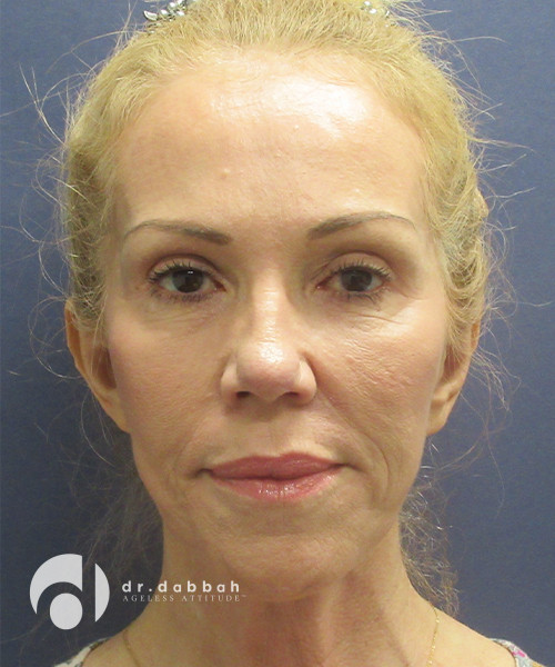 after sculptra front view female patient case 2299