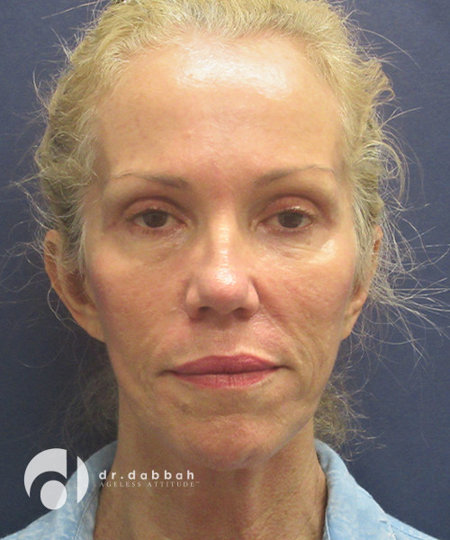 before sculptra front view female patient case 2299